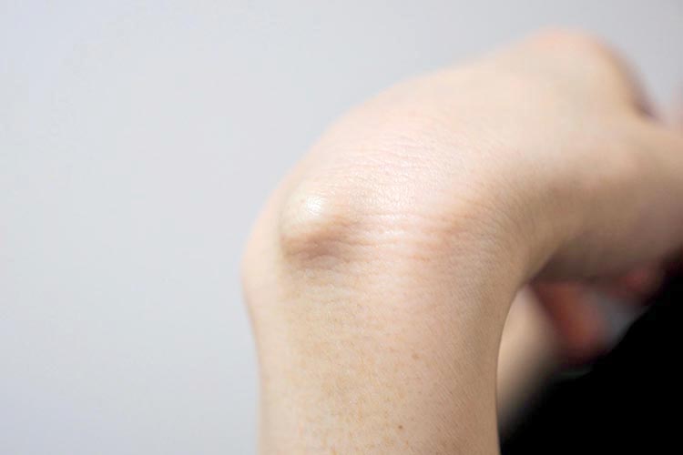 骨軟部腫瘍のイメージ画像